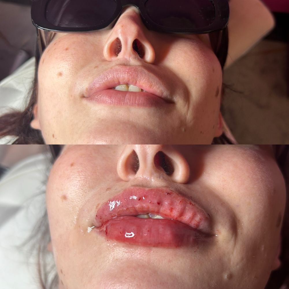 Hylauronic Pen Lip Fillers