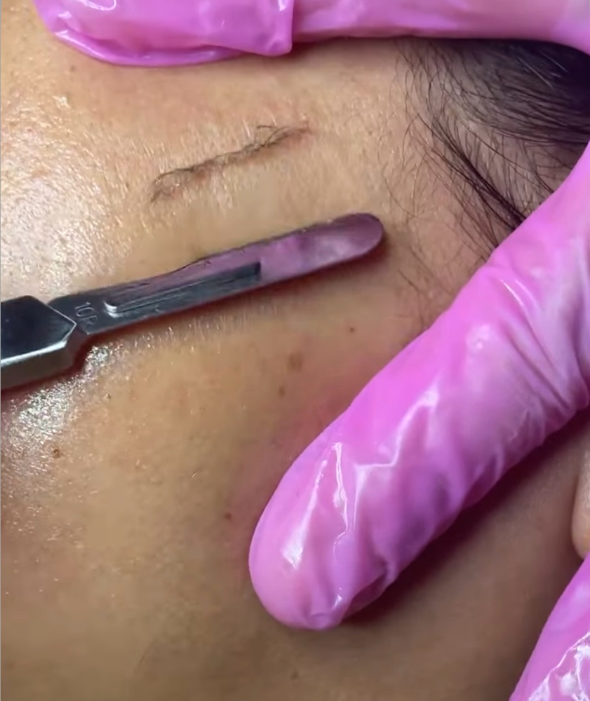 Dermaplaning