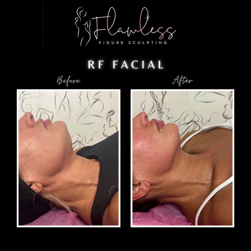 RF Facial Package - 4