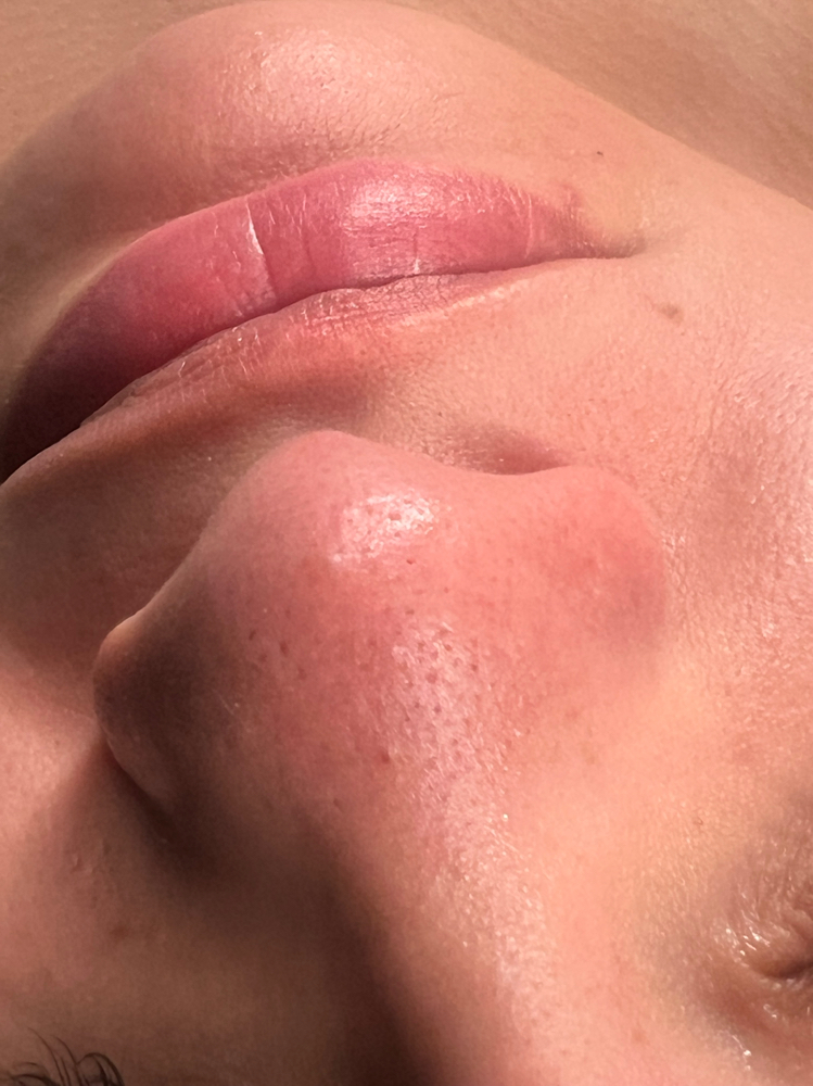 Lip & Chin
