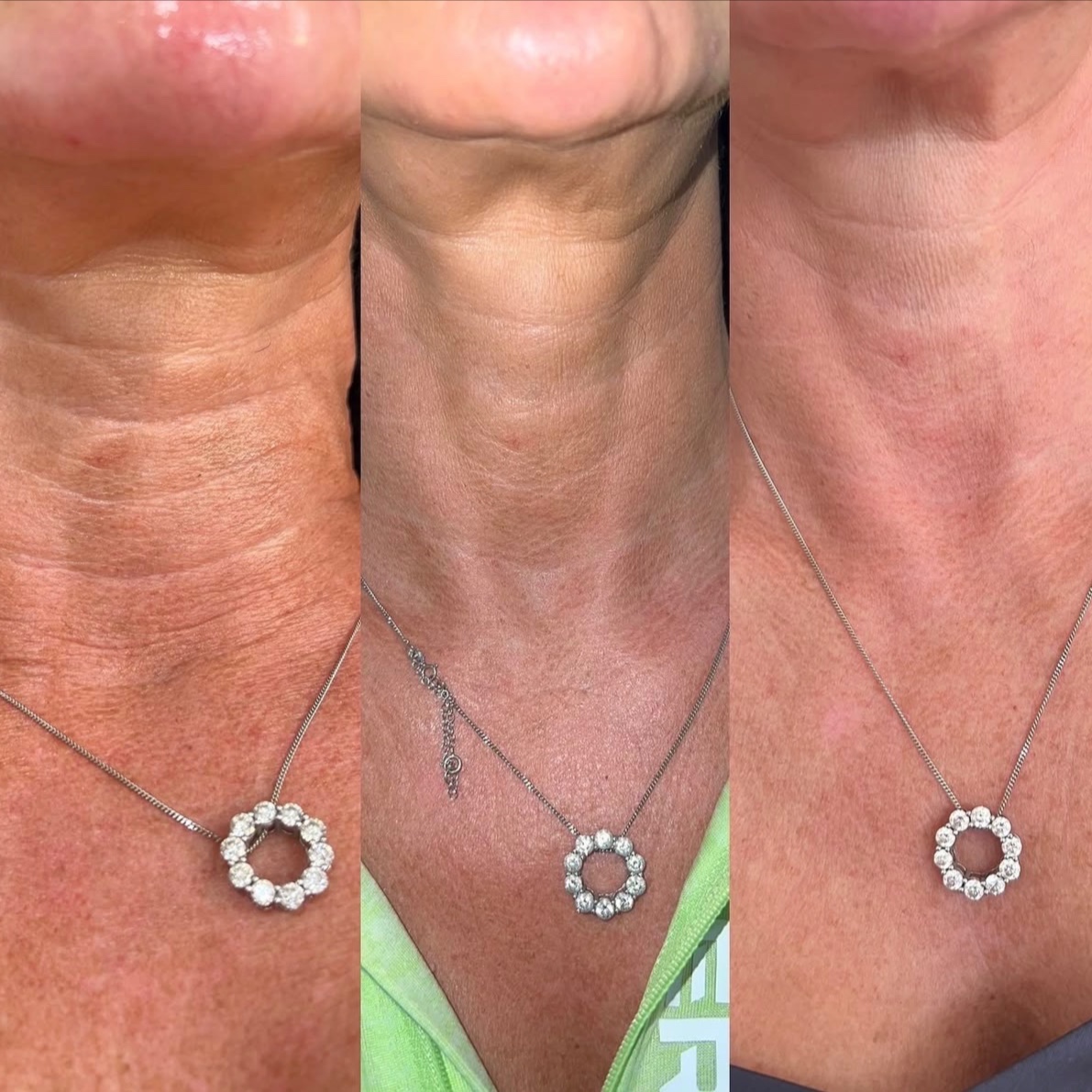 NECK MICRONEEDLING | ADD-ON at LEXTHETICS | Powered by Smiley Aesthetics & Dr. Katrina Briggs, MD in Columbus, OH