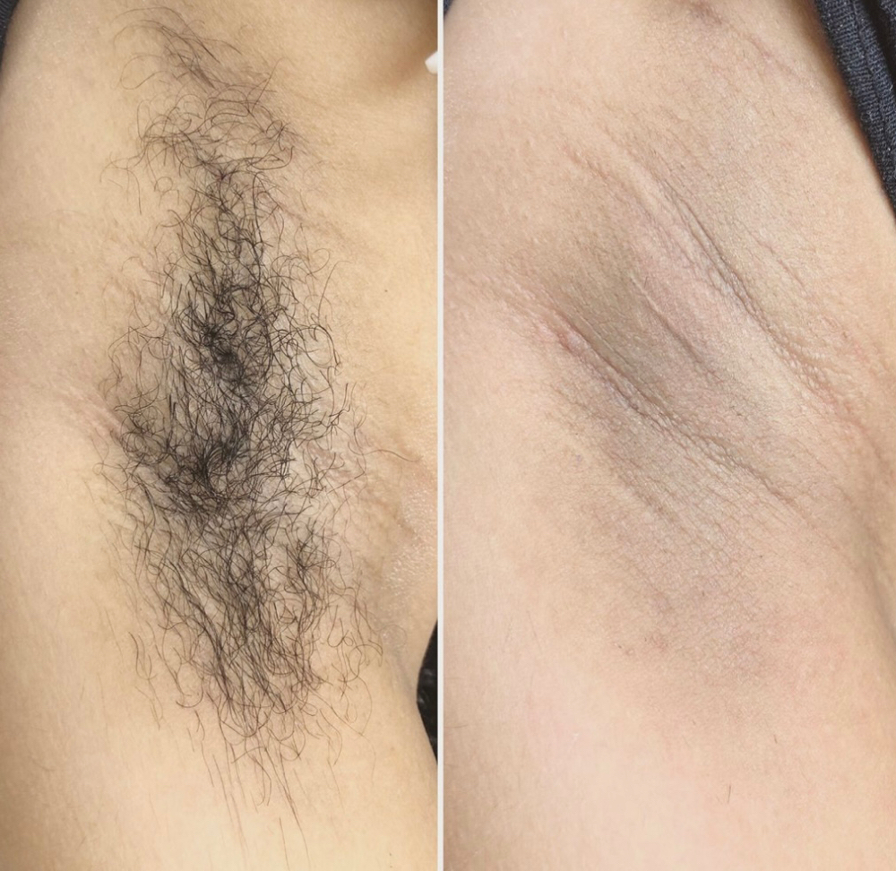 Underarm Wax