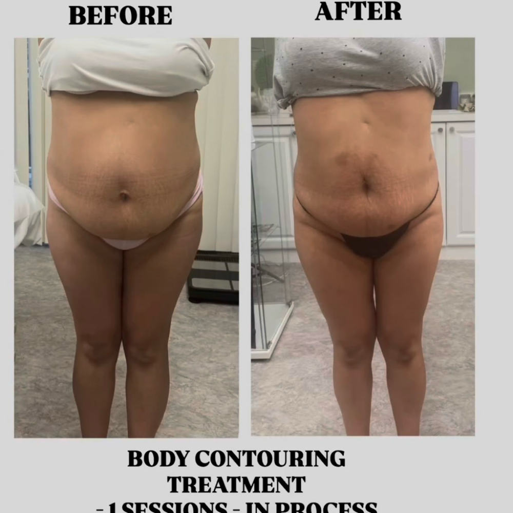 Hidrolipoflack at Any Beauty Aesthetics Care in New York, NY
