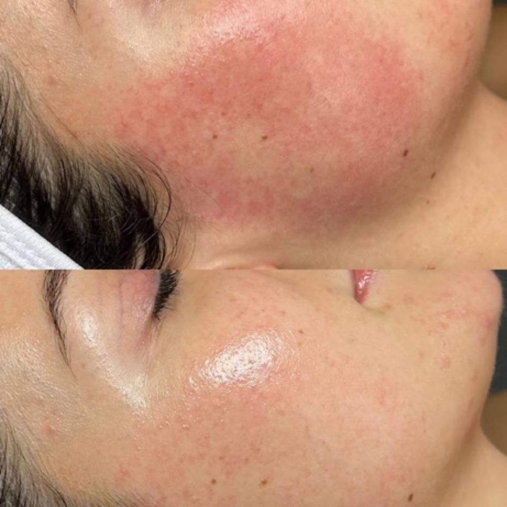 Rosacea Relief Facial at Bare Beauty By Alexis in Bay Saint Louis, MS