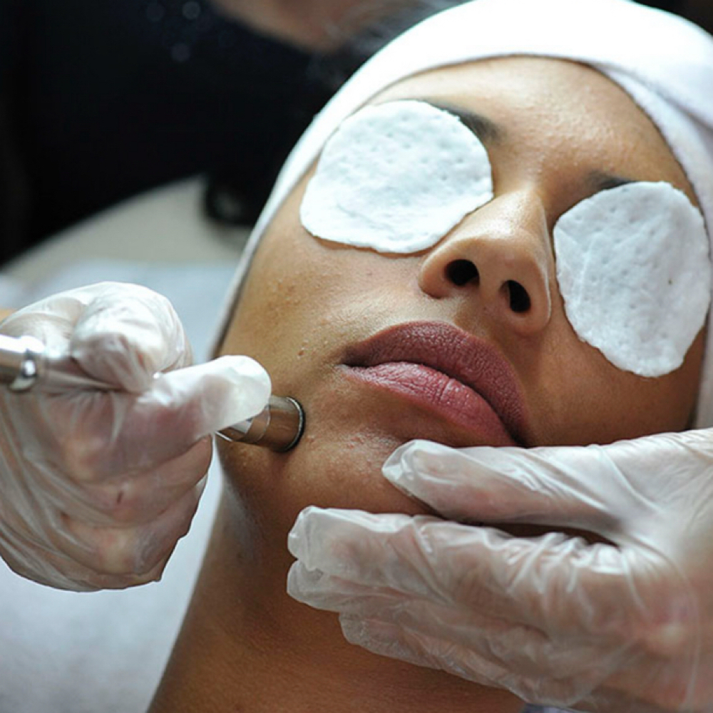 Microdermabrasion Facial at Esthetics by Kira in Redding Ca, CA