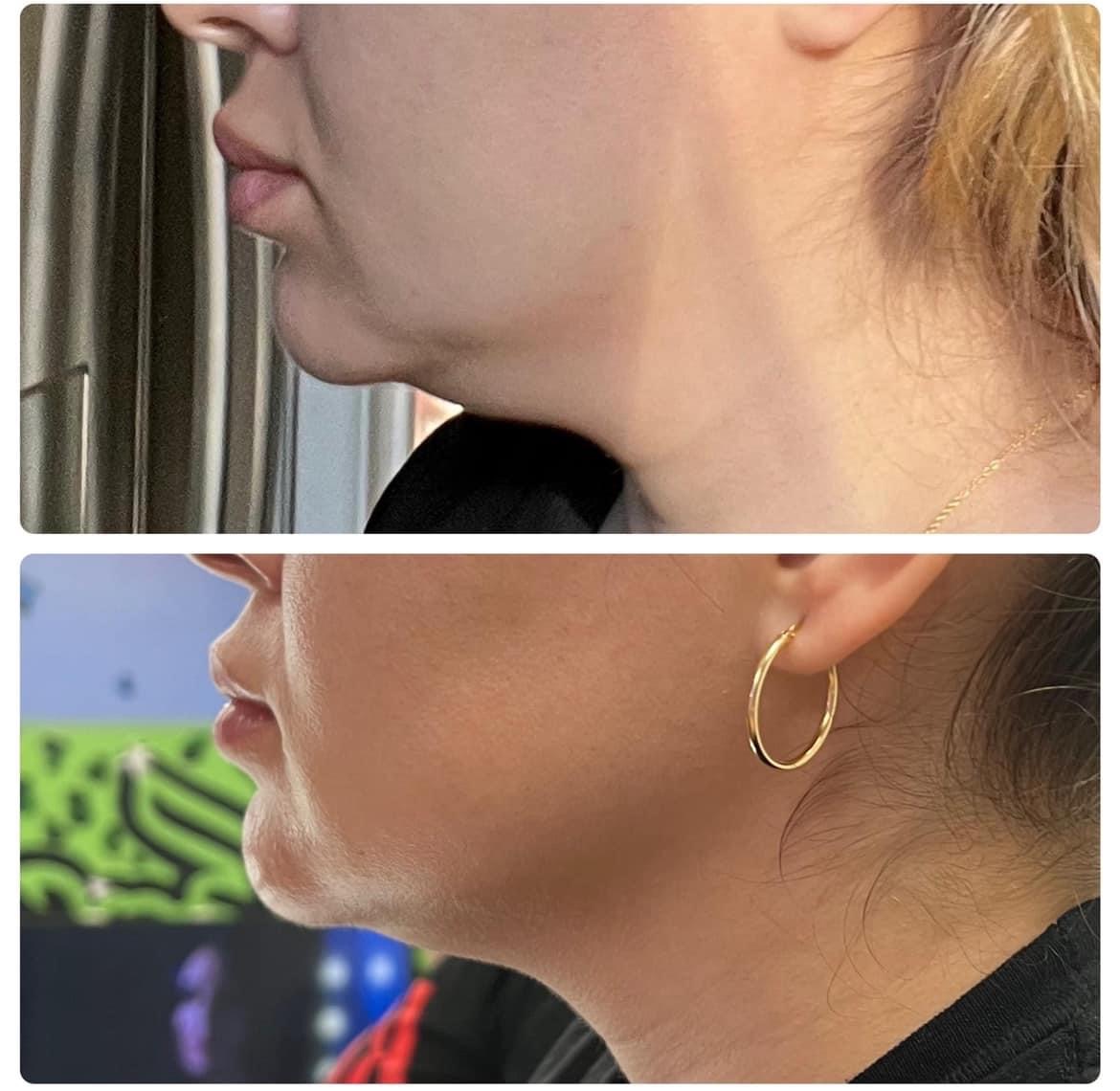 1 Hour Neck & Chin Lift