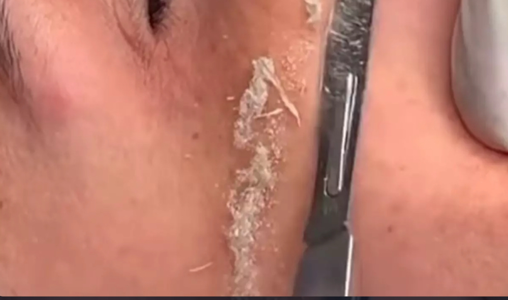 Dermaplane Facial