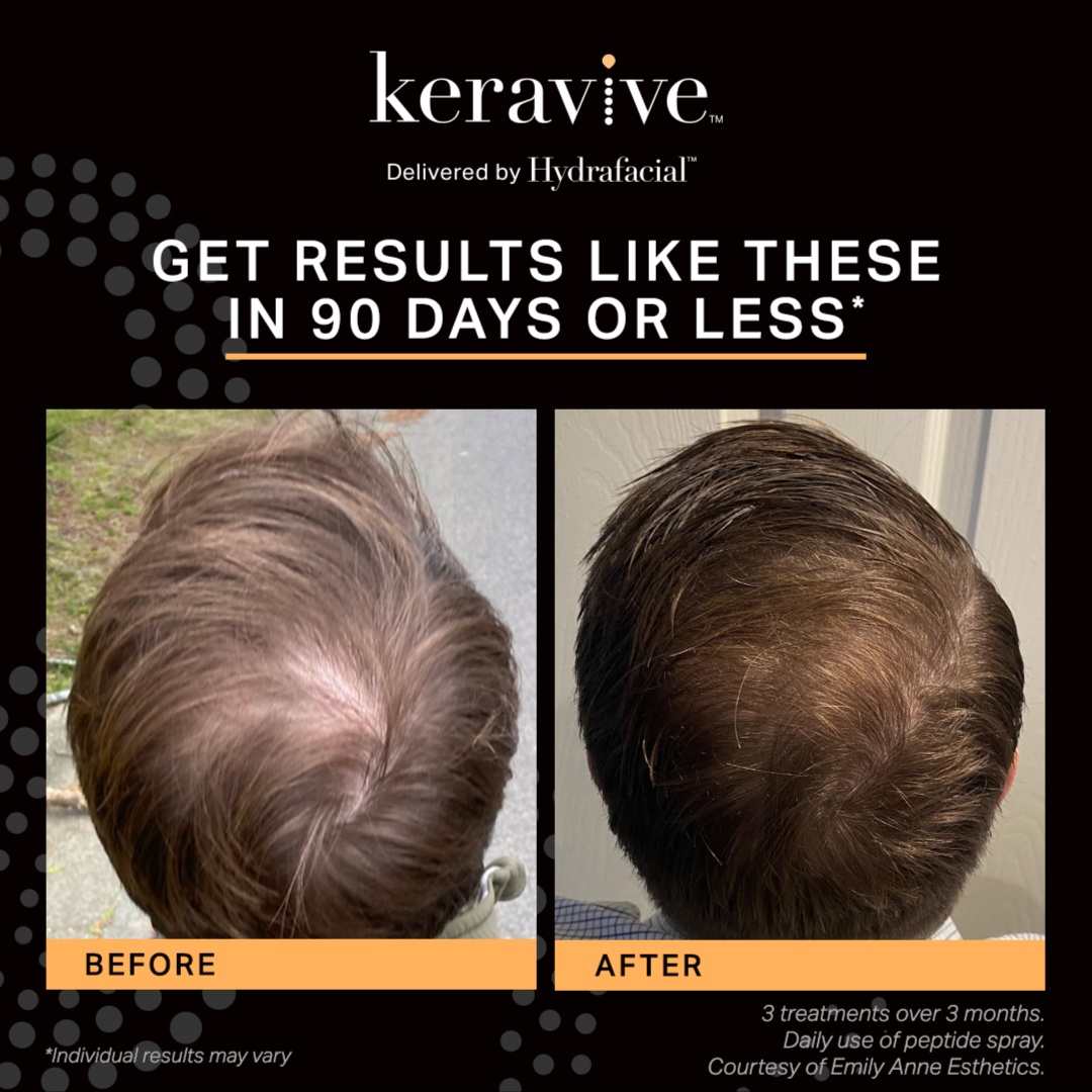 Keravive Growth Scalp Treatment at LB Glow Esthetics in Pacific Grove, CA