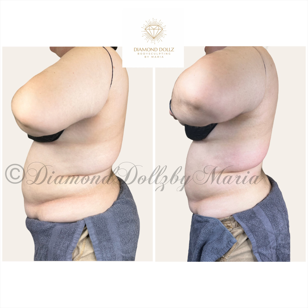 Mommy Make Over ( Stomach & Sides)