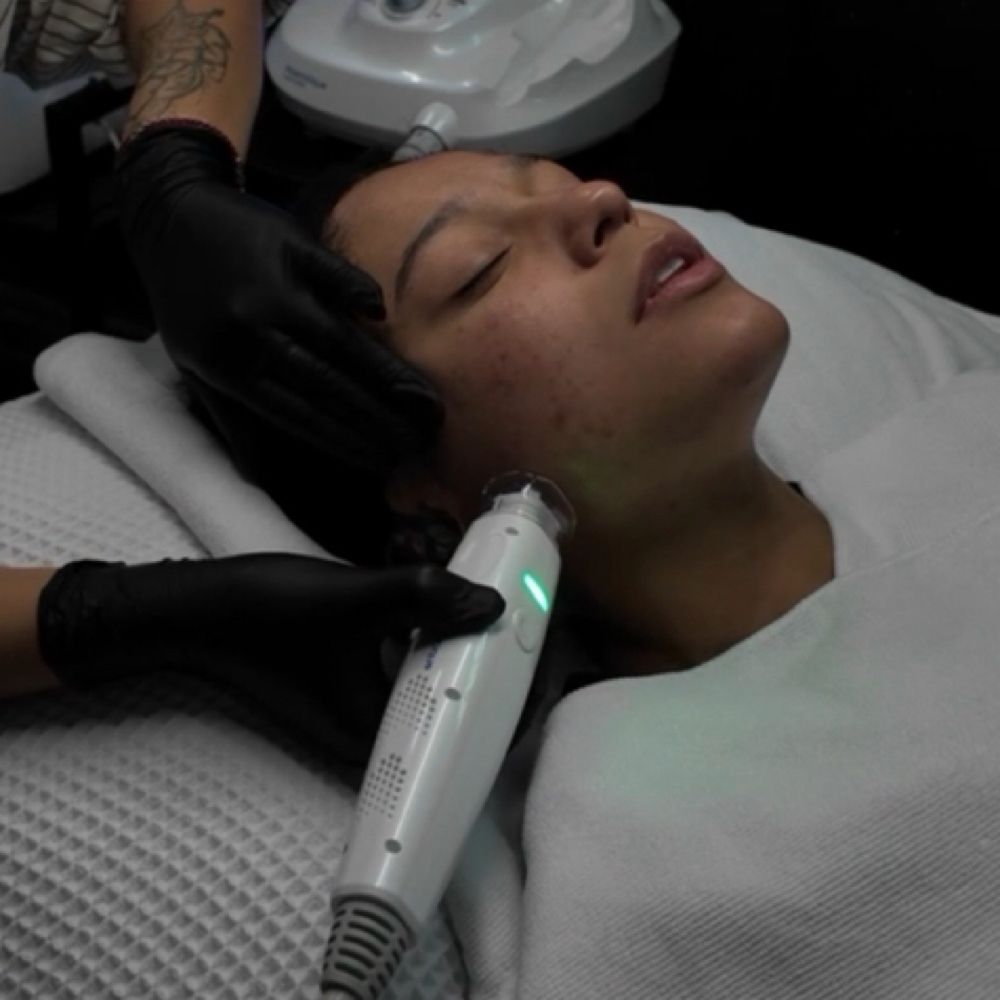 Cold Plasma Skin Renewal at Piel Studio in Fullerton, CA