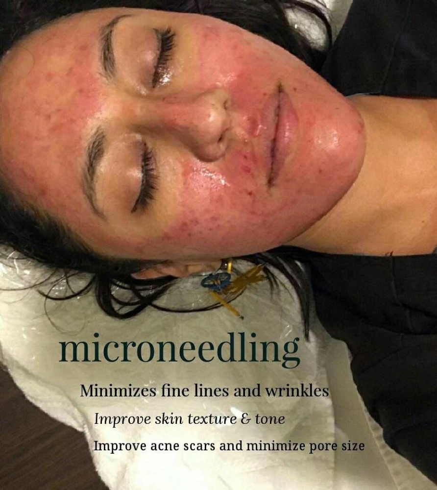 Microneedling