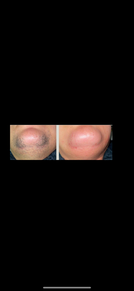 Chin Wax