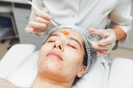 Chemical Peel Add On