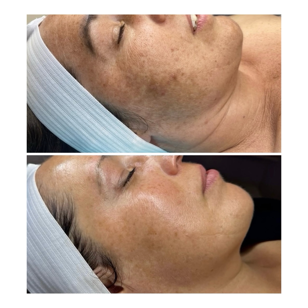 Lazer Peel- 1 Treatment at Haylee Jade Esthetics LLC in Ellijay, GA