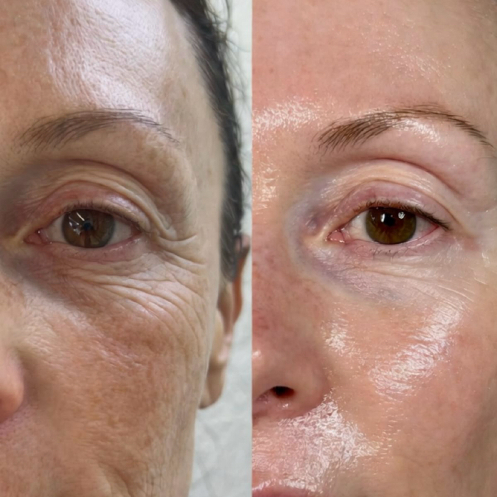 Lazer Peel- 1 Treatment at Haylee Jade Esthetics LLC in Ellijay, GA