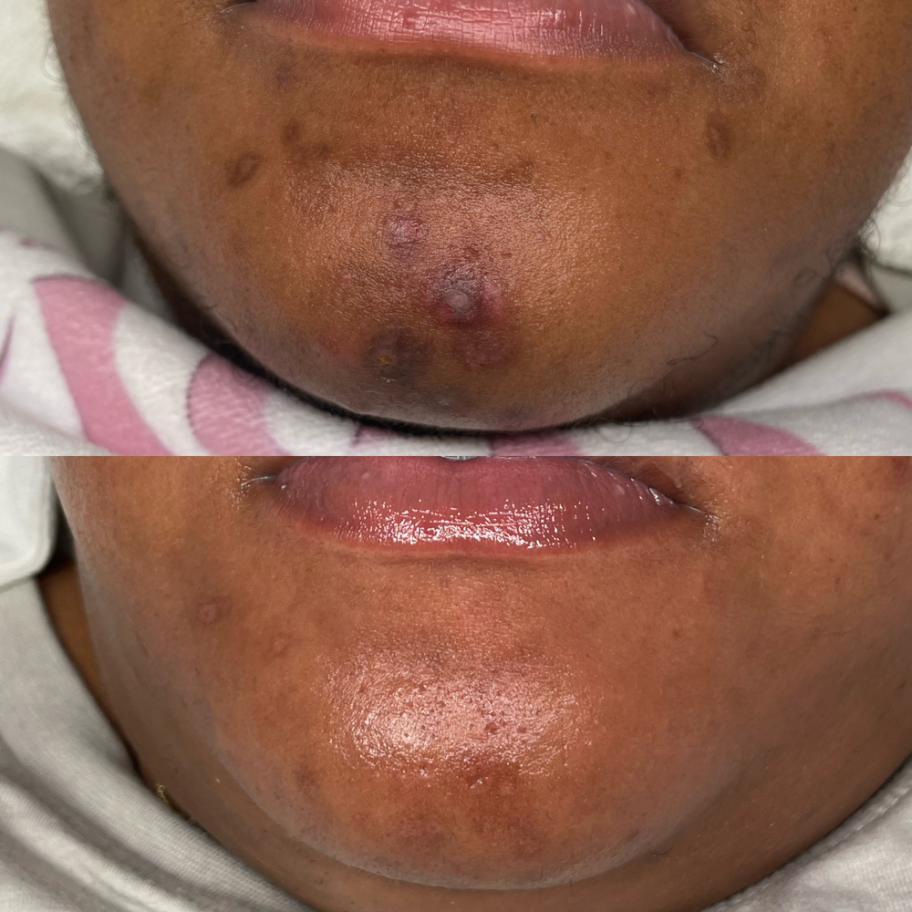 Pigment Control Chemical Peel
