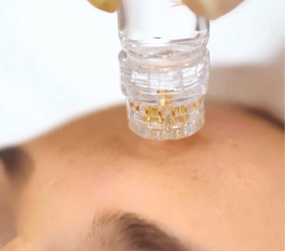 Botox Facial