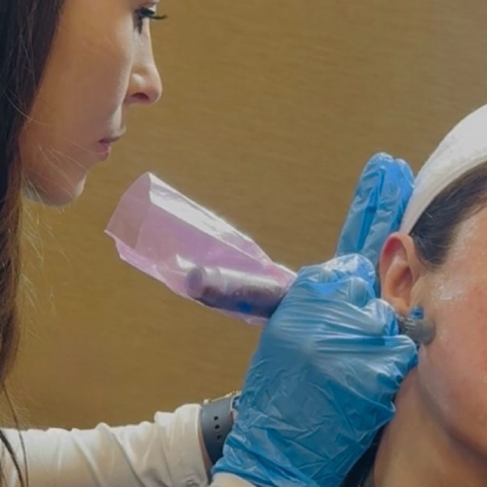 Microneedling at Revive Aesthetics and Wellness in Ingleside, TX