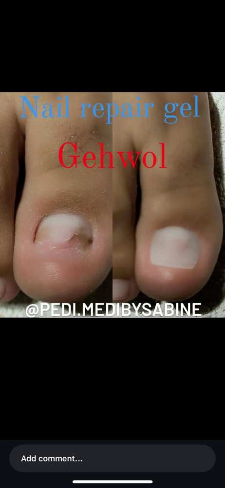 Toenail Reconstruction at Pretty Pedicures in Upland, CA