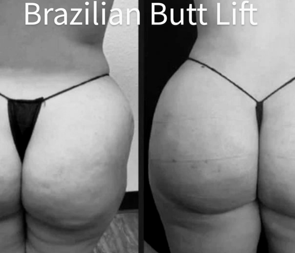 Brazilian Butt Lift Package