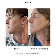 Body- Neveskin Facial 10 Pack