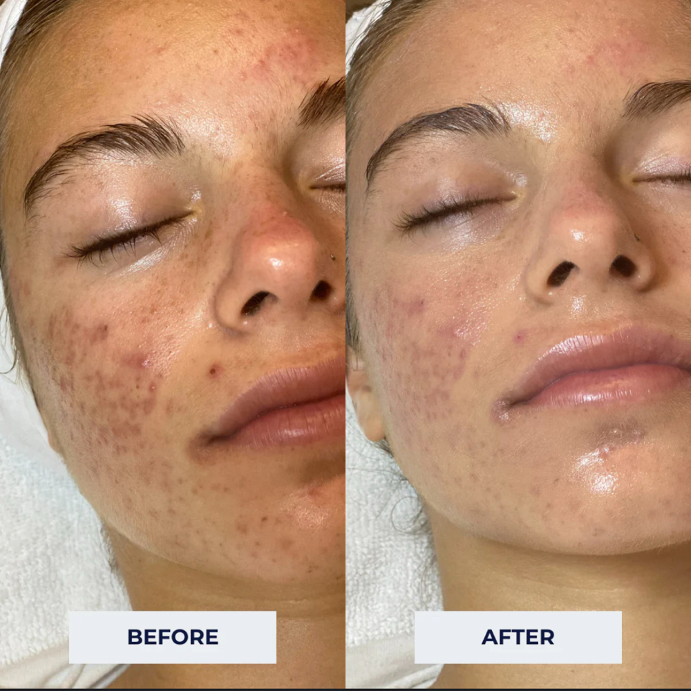 Teen facial at MylaSkinCare in Los Angeles, CA