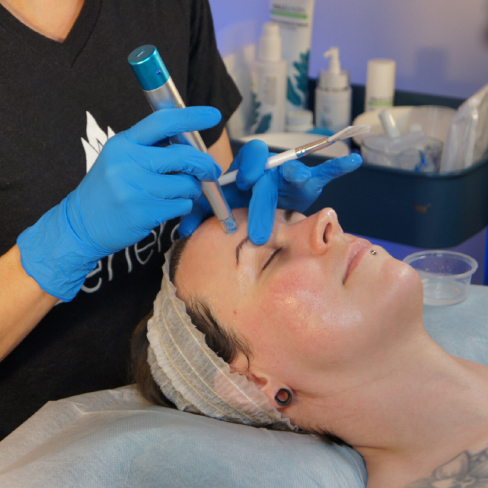 Rezenerate Nano Infusion-Full Face at Beautyful Aesthetics in Edmond, OK