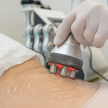 Radio Frequency (RF) Treatment at Beba Beauty & Spa in FLOWERY BRANCH, GA