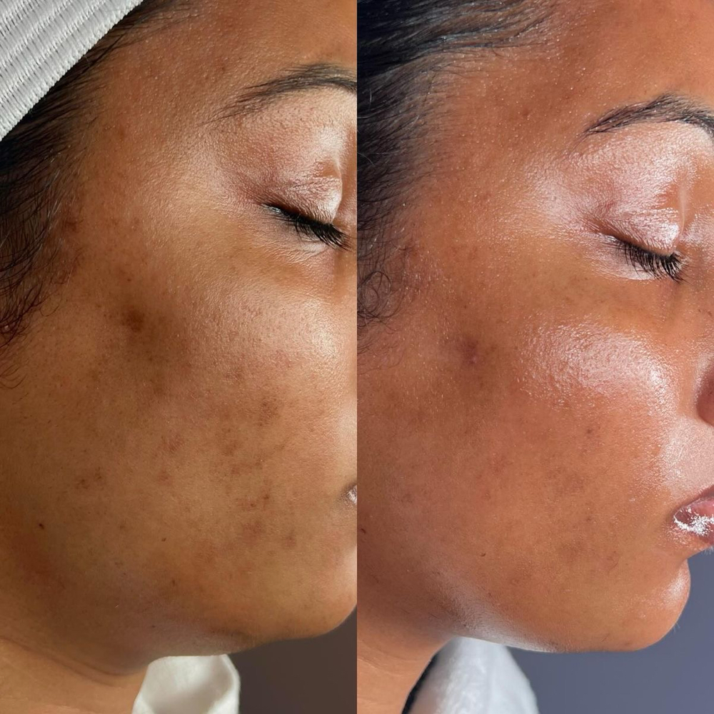 CORRECTIVE FACIAL TREATMENTS