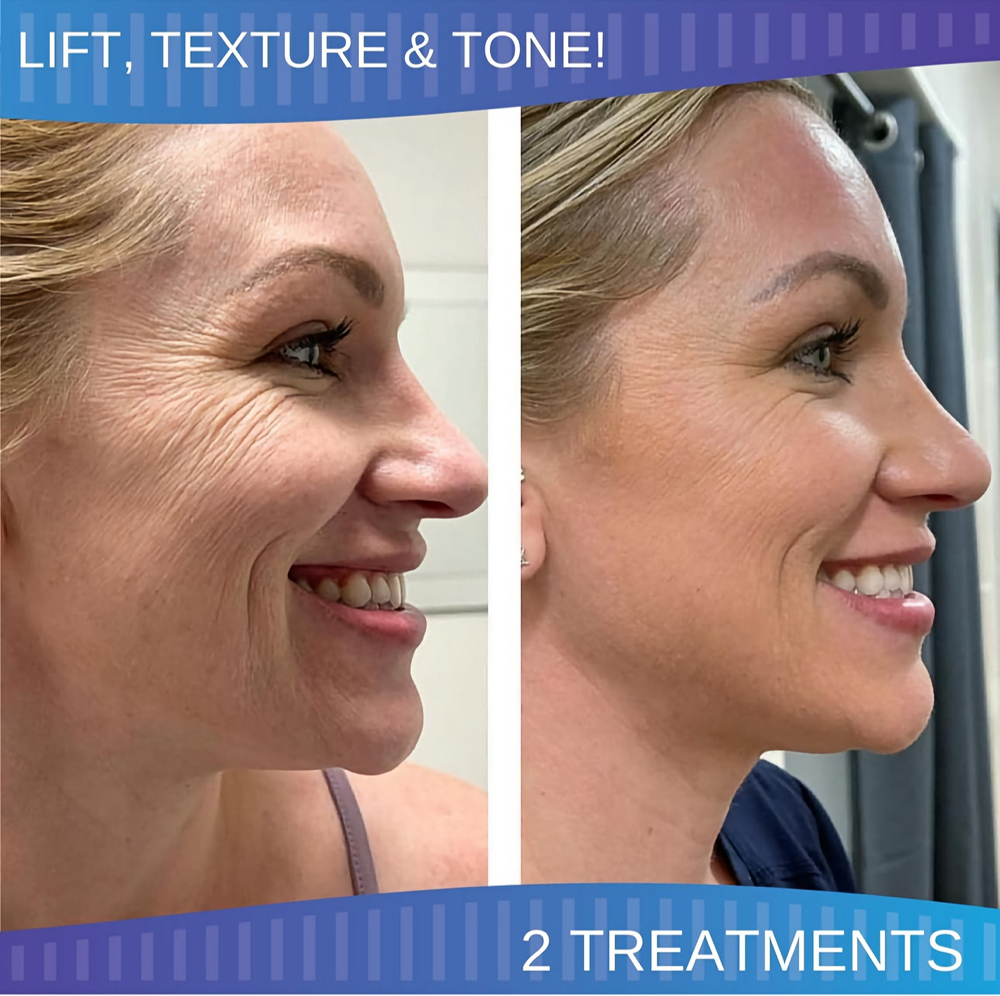 Procell Microchanneling