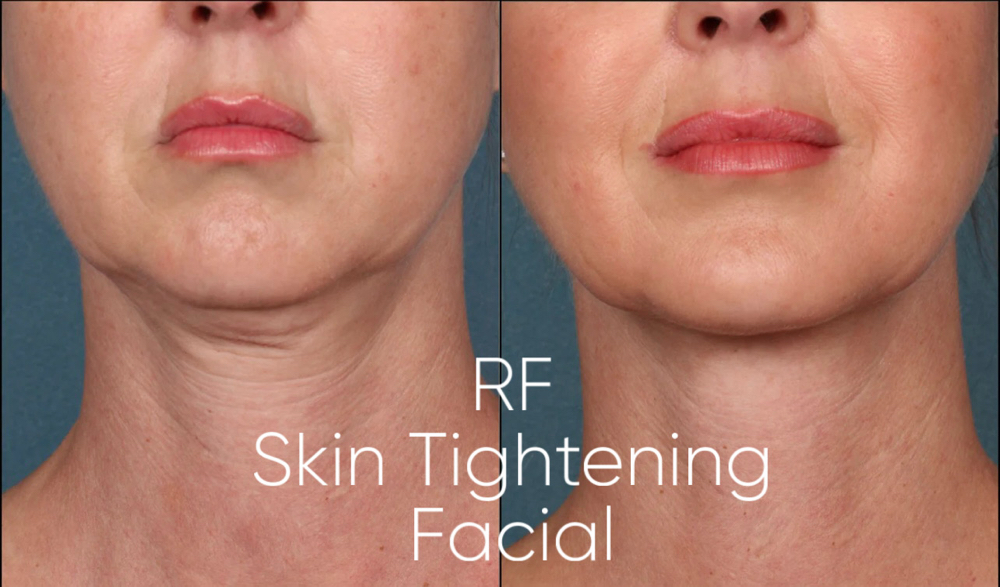 Enchantè Face Tight Treatment