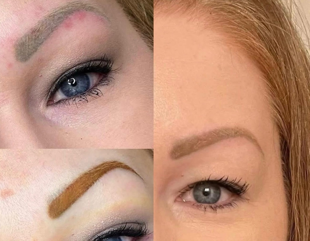 Brow Correction