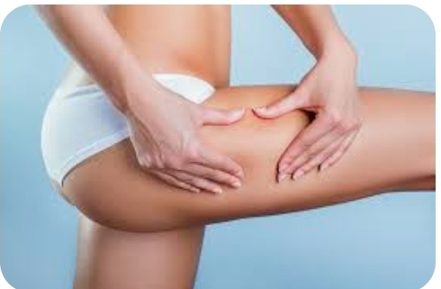 Cellulite Reduction ( Legs)