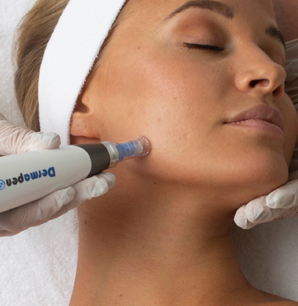 Microneedling + über Peel