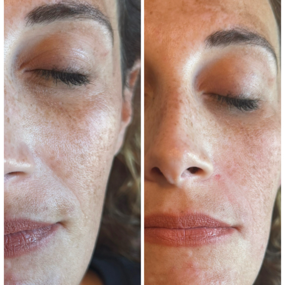 Dermal Filler (Facial Balancing) at Agoddess Spa & Wellness in DeSoto, TX