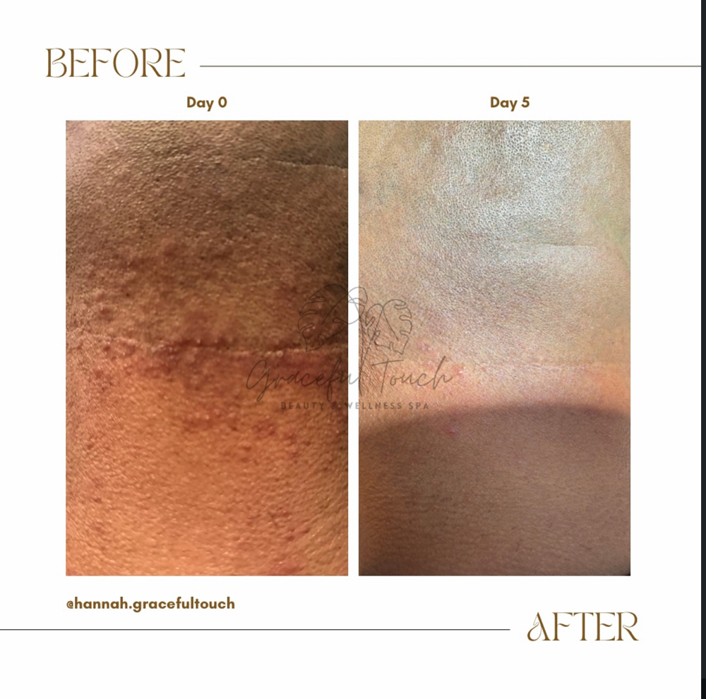 PFB (Pseudofolliculitis Barbae)