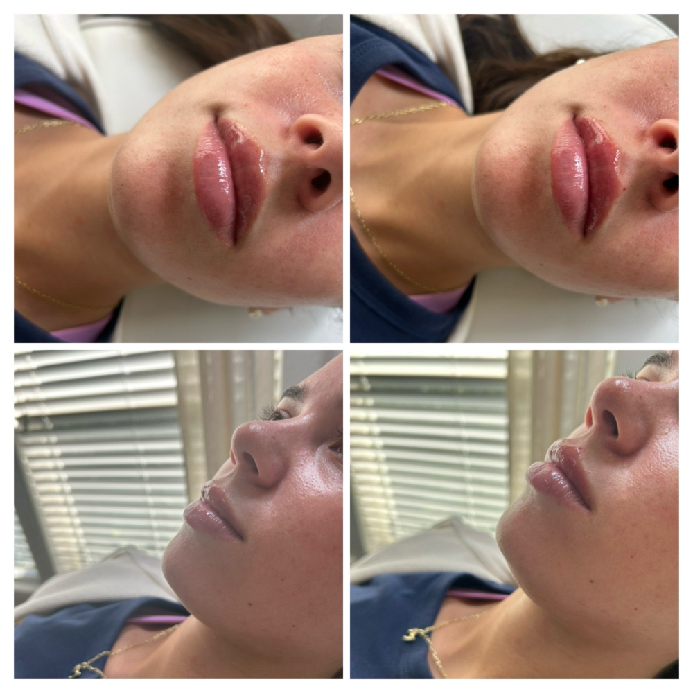 Lip Flip at Kat Marie Aesthetics in Humble, TX