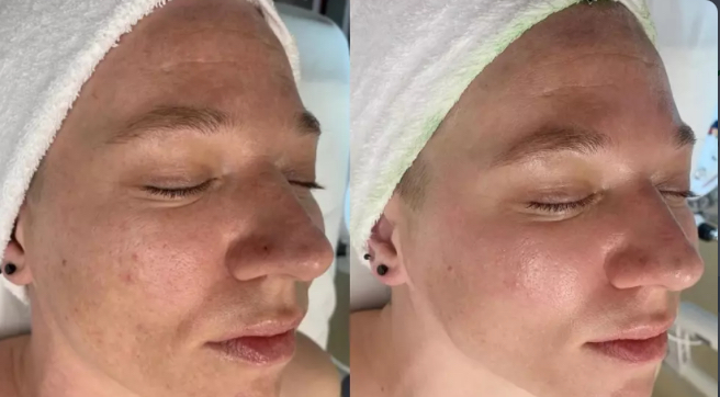 LED Light Therapy