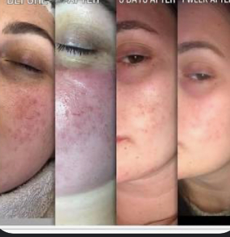 Dermaplan+Microneedle+Peel