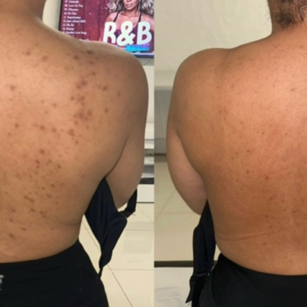 Organo Herbal Peel (Back) at Sonder Skin in Newport News, VA