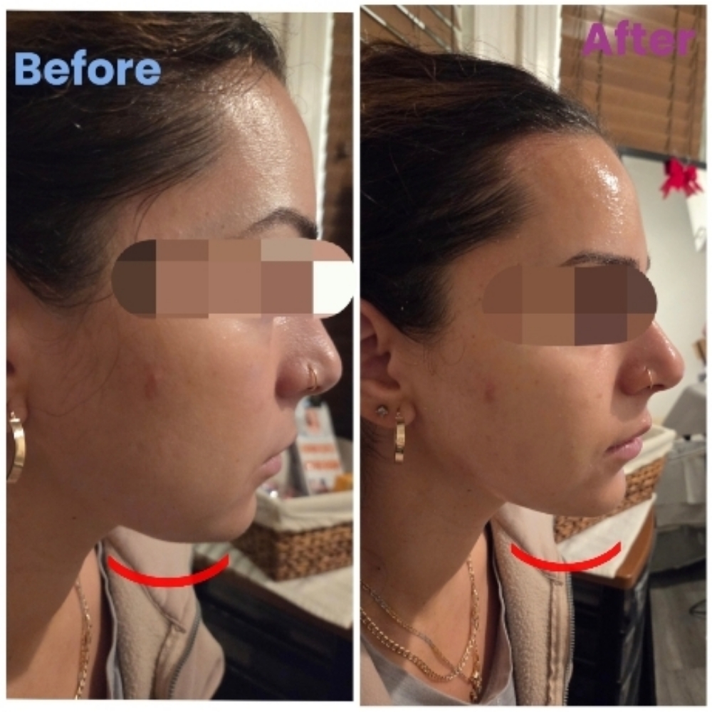 HiFu For Jawline And Chin at Sun Skincare LLC in Scottsdale, AZ