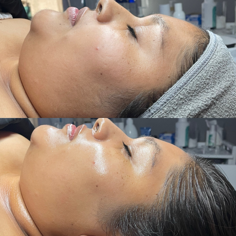 Intermediate Facial