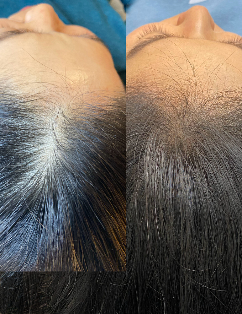Hair Restoration