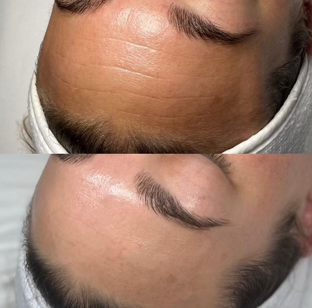 Diamond Microdermabrasion Facial