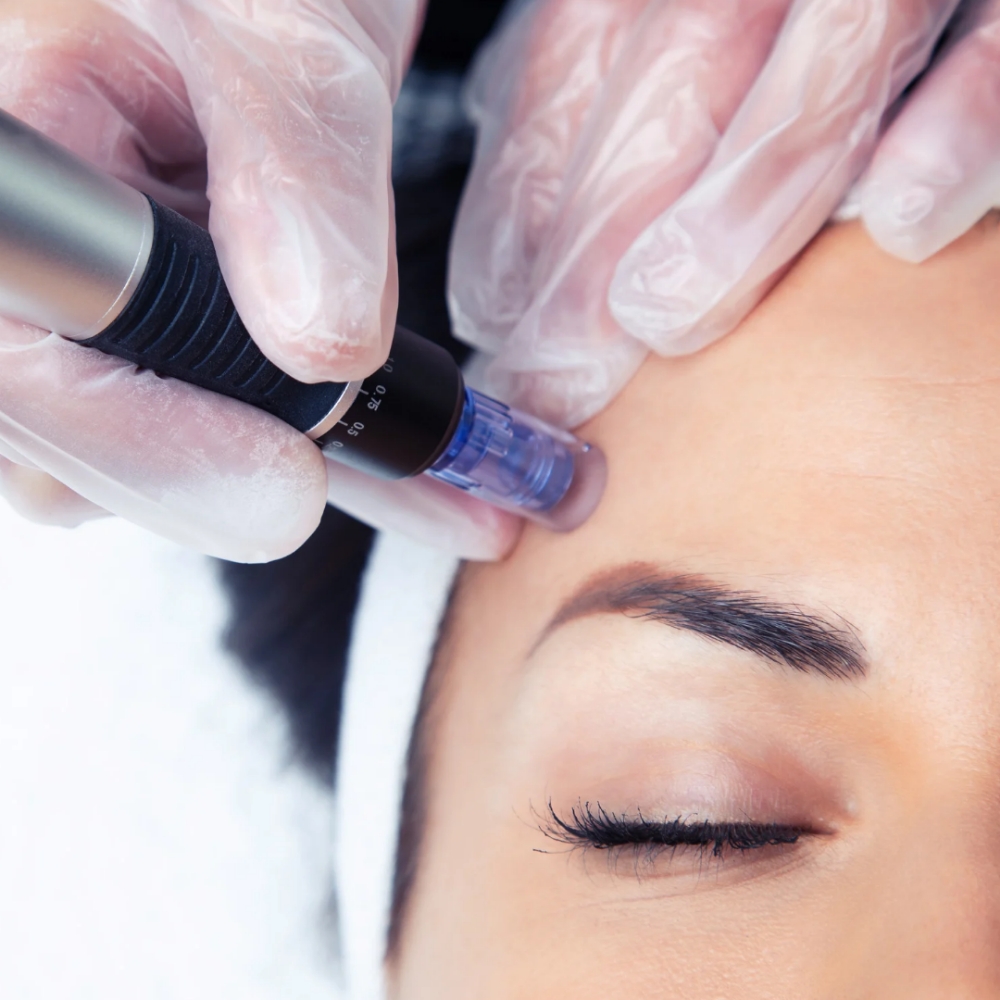 Micro Facial Micro-Needling at Kelleen The Esthetician in Millcreek, UT
