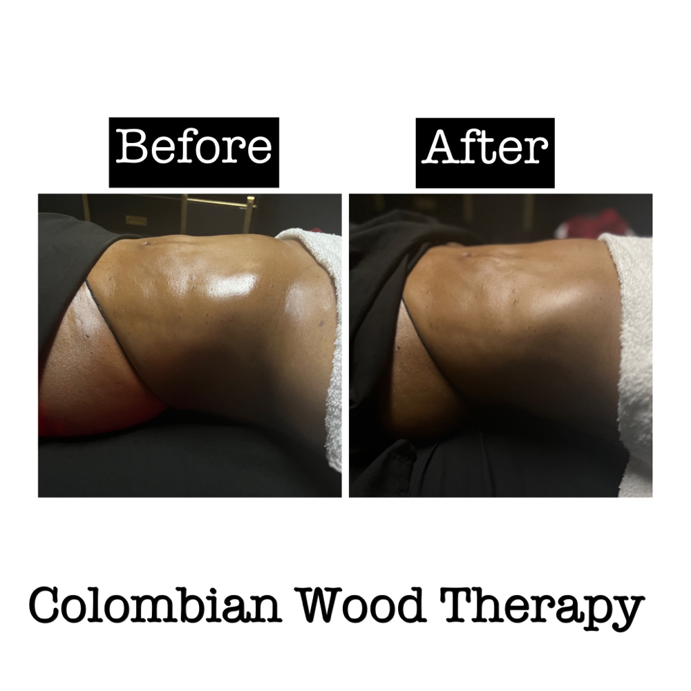 Colombian Wood Therapy-5 Package at Wholistic Recovery & Wellness Spa in Snellville, GA