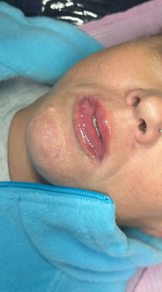 Lip Fillers