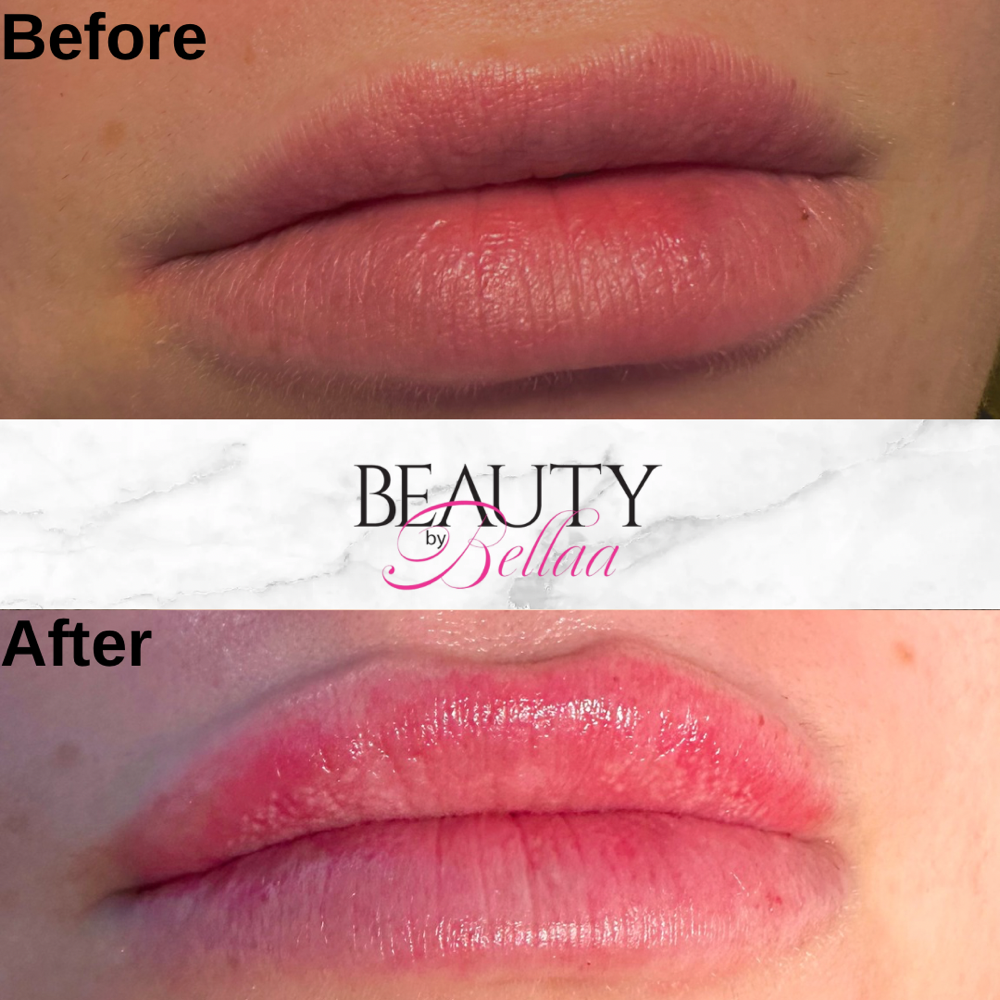 Lip Fillers