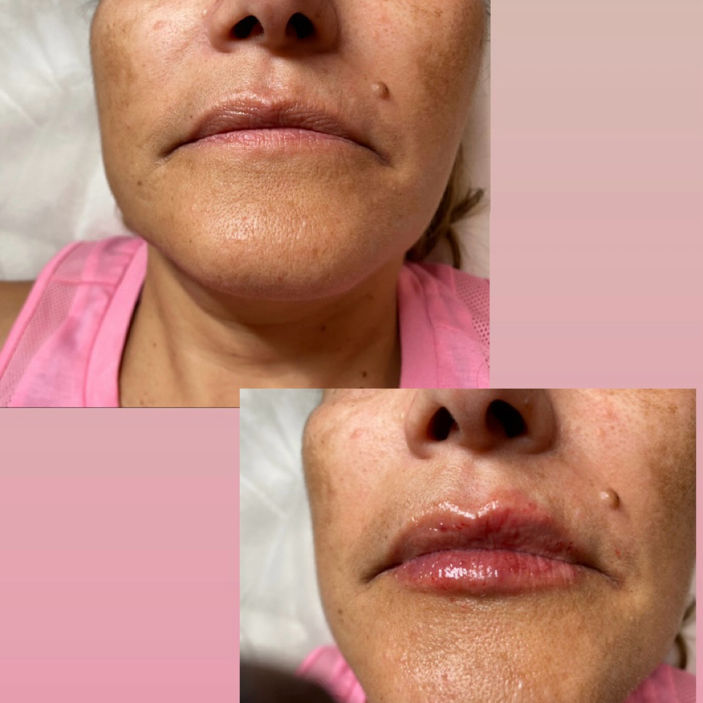 Half Syringe Lip Enhancement at Ruby’s Beauty Bar in Davenport, FL