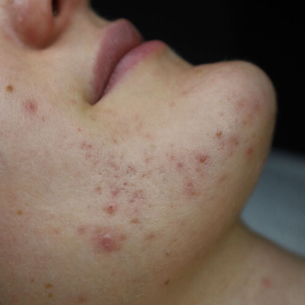 Virtual Acne Consulation 1 at Aura Esthetics in Wichita, KS